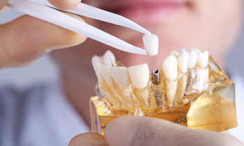 Postup implantace zubů od našeho lékaře